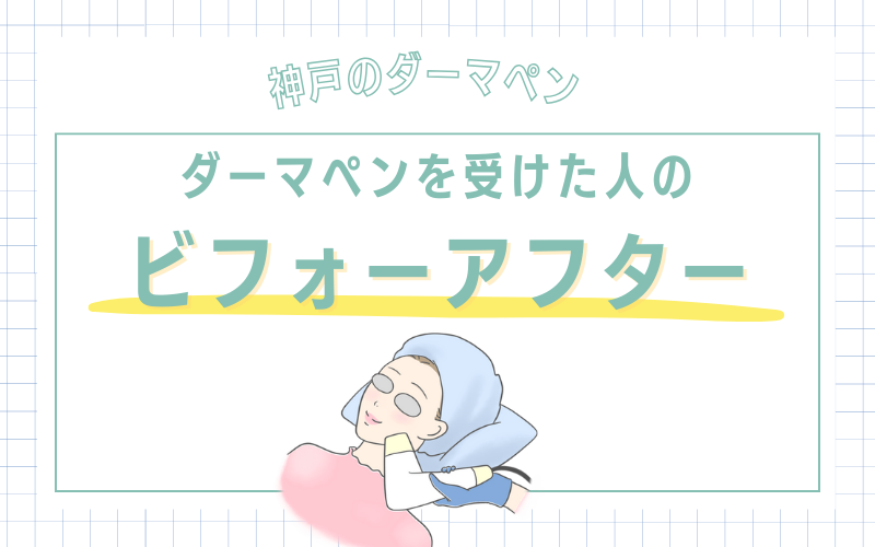 神戸でダーマペンを受けた人のビフォーアフター写真