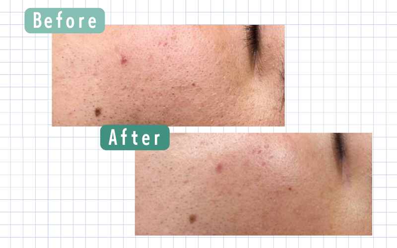 ダーマペン1回目