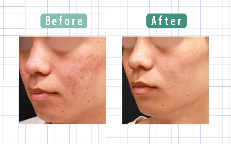 ダーマペン13回目