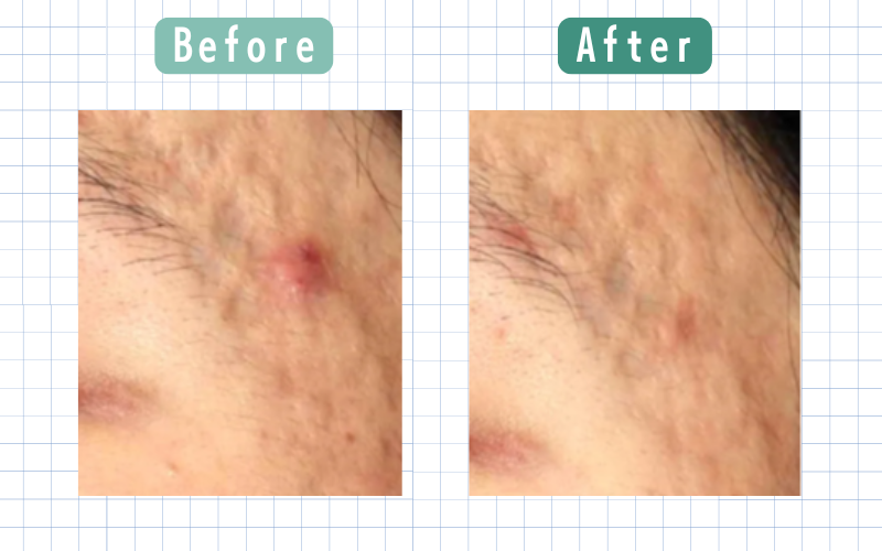 ダーマペン3回目