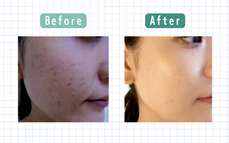 ダーマペン5回目