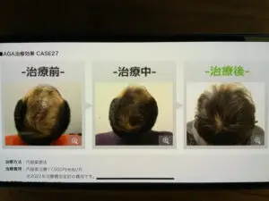 症例写真　銀クリ　銀座総合美容クリニック