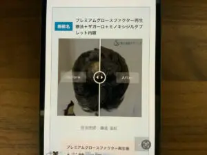 症例写真　聖心毛髪再生