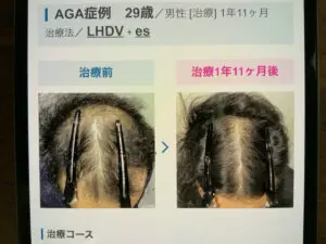 症例写真　ウィルAGAクリニック